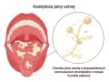 Ilustracja przedstawia jamę ustną z białymi nalotami na języku i podniebieniu, wskazującymi na kandydozę. Obok powiększony obraz drożdżaków Candida.