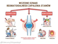 Wczesne objawy zapalenia stawów: sztywność, ból po bezczynności, opuchlizna, utrata apetytu, zmęczenie, gorączka.