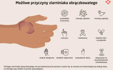 Dłoń z widocznym ziarniniakiem obrączkowatym. Obok ikony symbolizujące możliwe przyczyny: choroby, cukrzyca, nowotwory, leki, alergie, uszkodzenia skóry, promieniowanie UV.