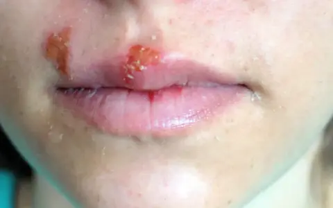 Obrzęknięte usta z widocznymi pęcherzykami i strupkami, objawy opryszczki.