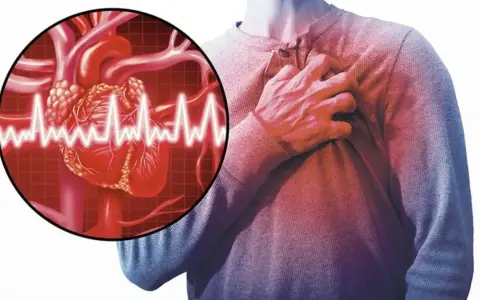 Człowiek trzymający się za klatkę piersiową, symbolizujący dusznicę bolesną. Obok grafika serca z zapisem EKG.