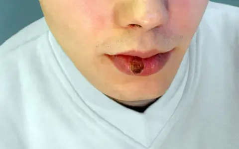 Zmiana na wardze, która może być objawem kiły.