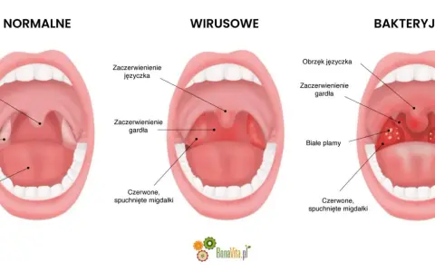 Porównanie gardła: normalne, wirusowe i bakteryjne. Objawy paciorkowca to m.in. białe plamy na migdałkach.