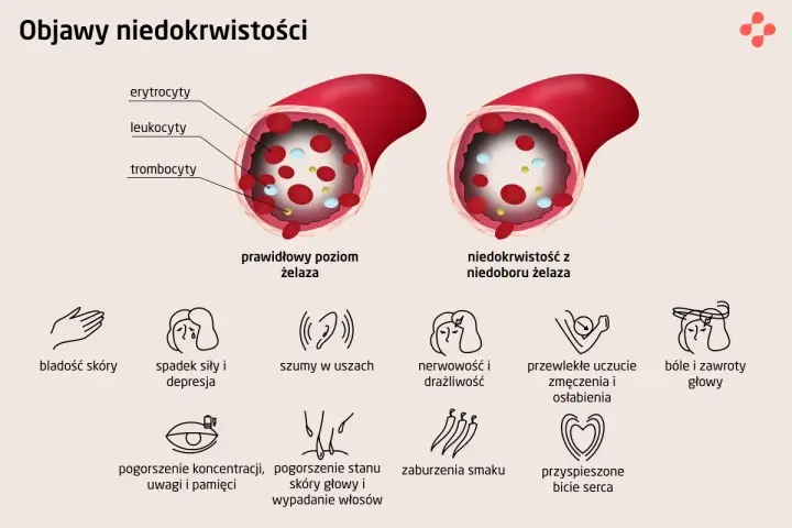 Prawidłowy poziom żelaza w naczyniu krwionośnym vs. niedobór żelaza. Objawy anemii: bladość, zmęczenie, szumy w uszach, bóle głowy.